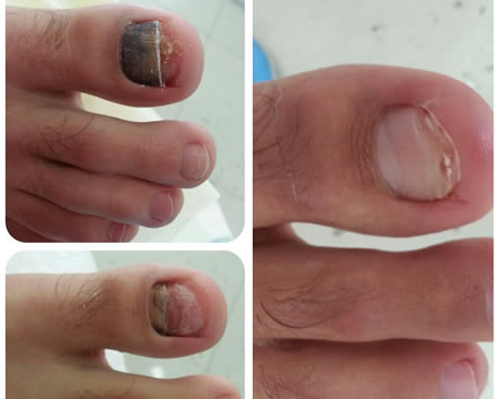 Trnak Mantar Bakm & Ayak Trnak Mantar Medikal Bakm