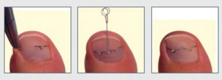 ingrown nail treatment, ingrown nail 3 to wire treatment, ingrown nail, 3 to wire system, ingrown nail treatment, ingrown toenail, ingrown toenail, ingrown nail treatment center