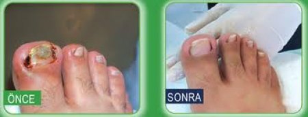 ingrown nail treatment, ingrown nail, ingrown toenail, ingrown nail treatment center, ingrown nail treatment, ingrown nail 3 to wire treatment, ingrown nail, 3 to wire system