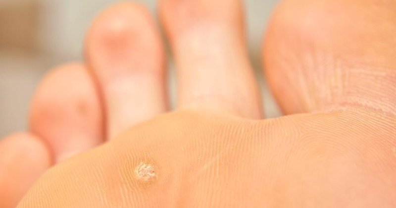 callus treatment, callus treatment, callus care, callus, foot callus treatment, definitive solution to foot callus