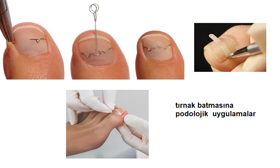  ,ingrown nail , ingrown nail treatment